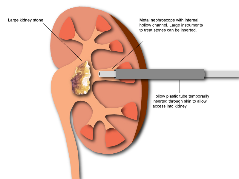 What are the steps involved in having a kidney removed?