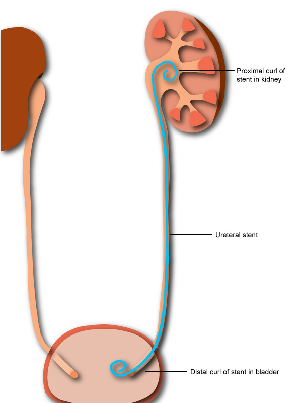 All About Ureteral Stents  Placement  Removal