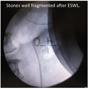 Xray of ESWL after
