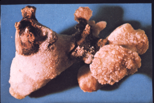 Photo of staghorn kidney stone