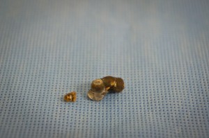 Photo of kidney stones removed percutaneously