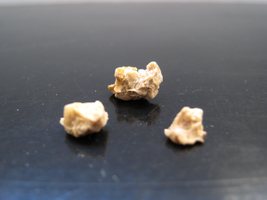 Photo of kidney stone fragments