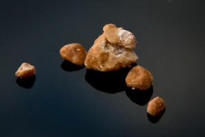 Photo of carbonate apatite kidney stones
